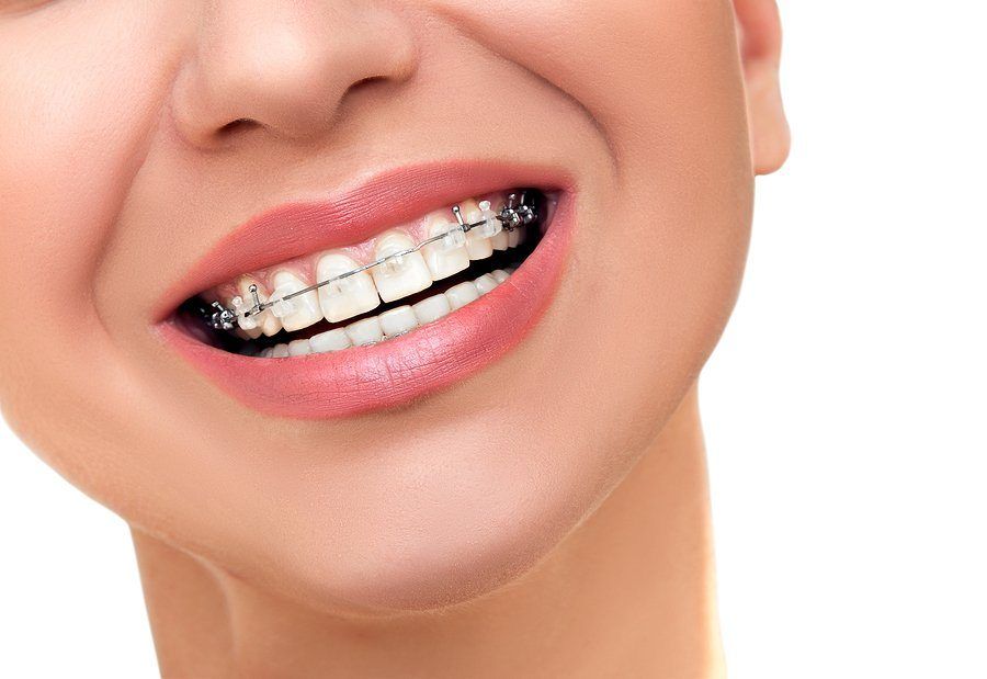 Best benefits of invisible braces