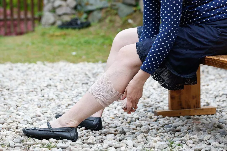 symptoms of varicose veins