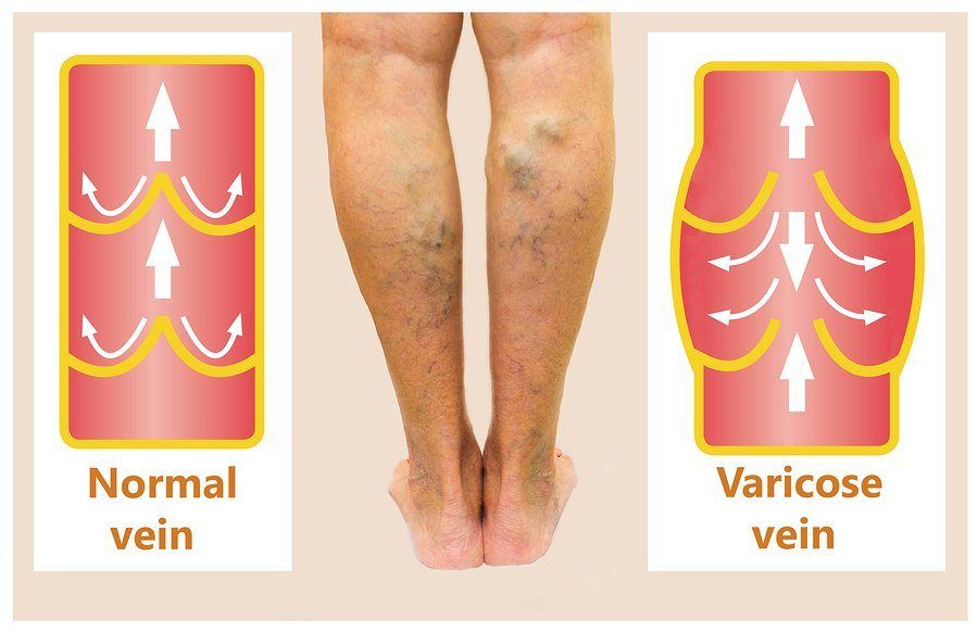 symptom of varicose veins