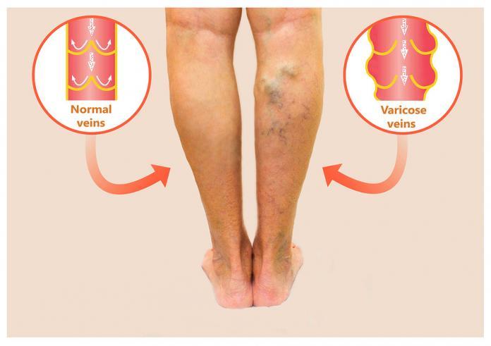 Important facts about varicose veins Varicose veins