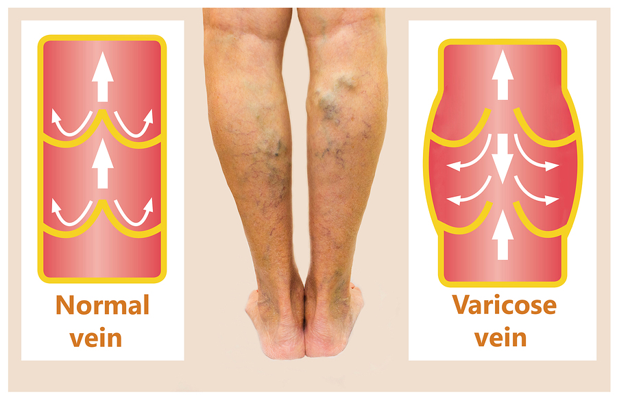 Causes of varicose veins