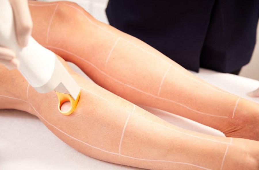 5 Best Hair Removal Services in Sydney – Leading Hair Removal Services