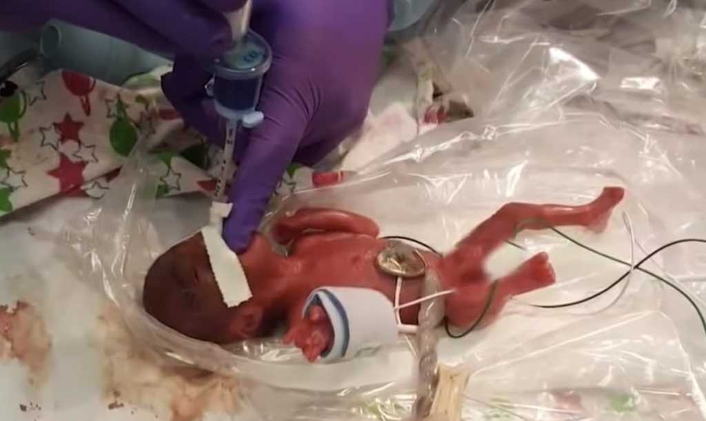 World’s smallest living infant born in U.S.