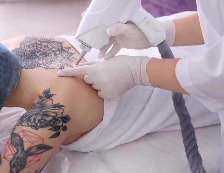 Best Tattoo Removal Services in Canberra