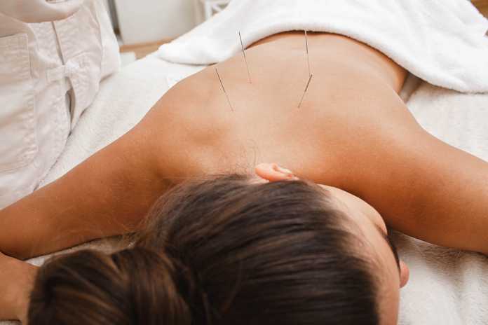 Acupuncture in Geelong Acupuncture in Geelong