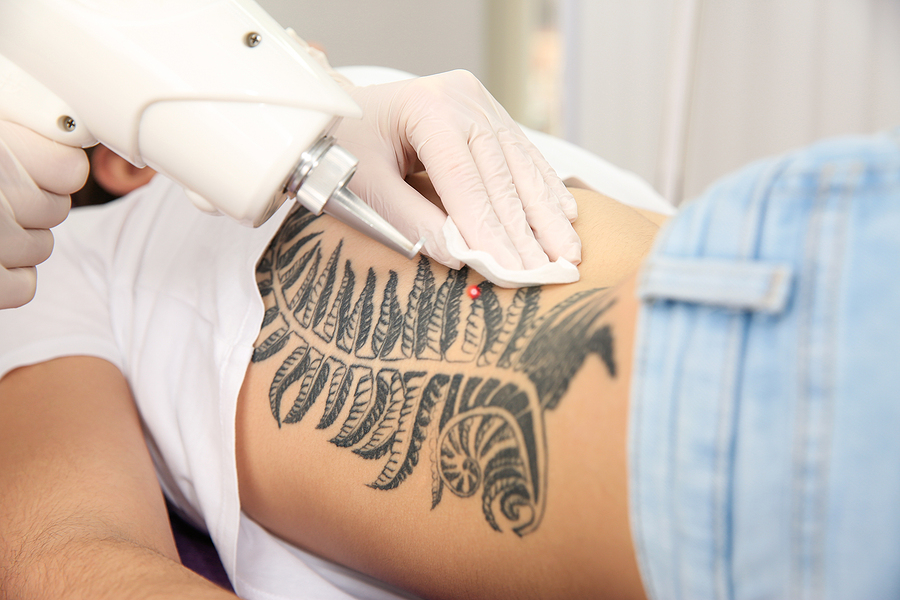 Effective tattoo removal systems