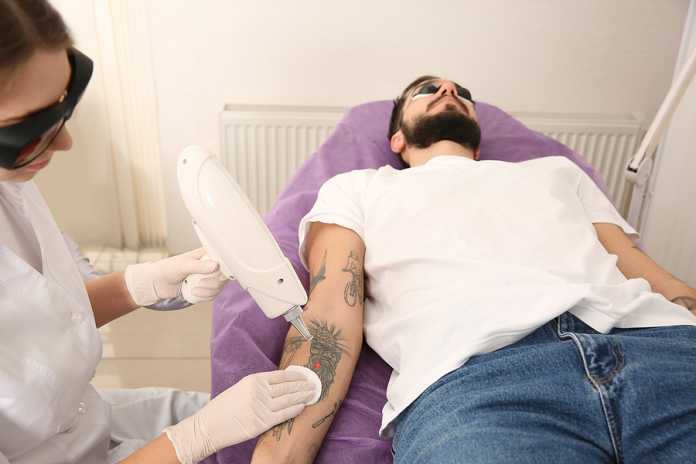 Laser tattoo removal machines are catching on in Australia Laser tattoo removal machines are catching on in Australia