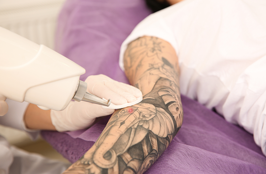 Removing tattoos with lasers